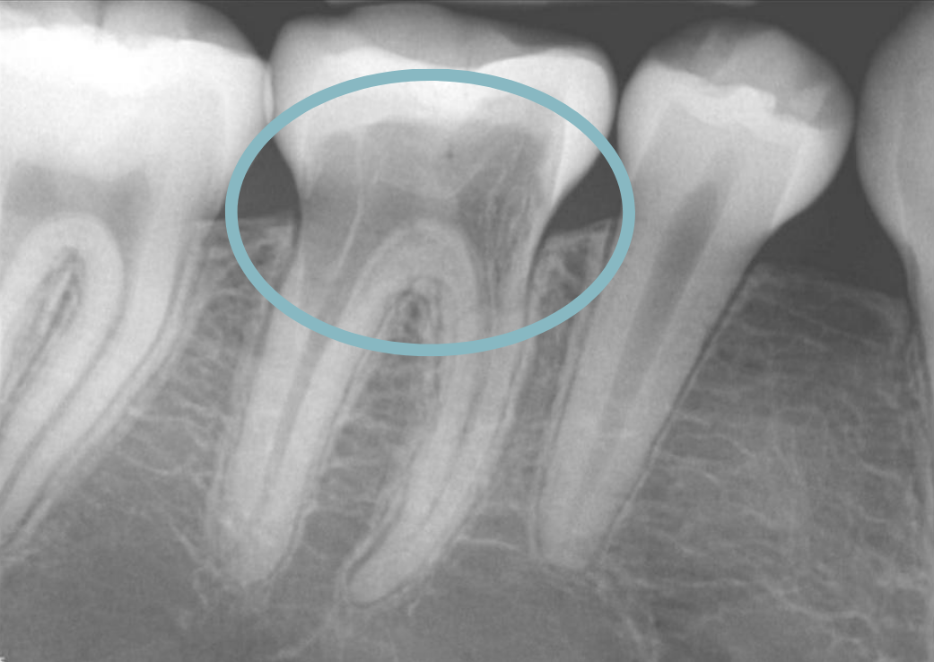 resorption definition teeth